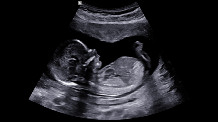 CCN fetal