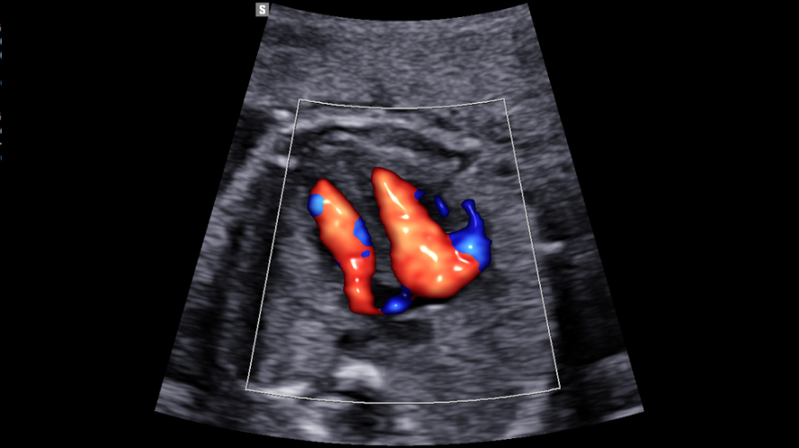 Corac╠ºa╠âo fetal